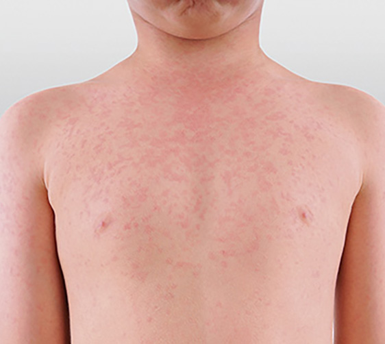  measles rash on child
