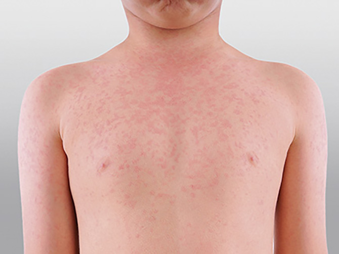  measles rash on child