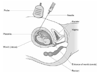 Figure 2: Chorionic villus sampling