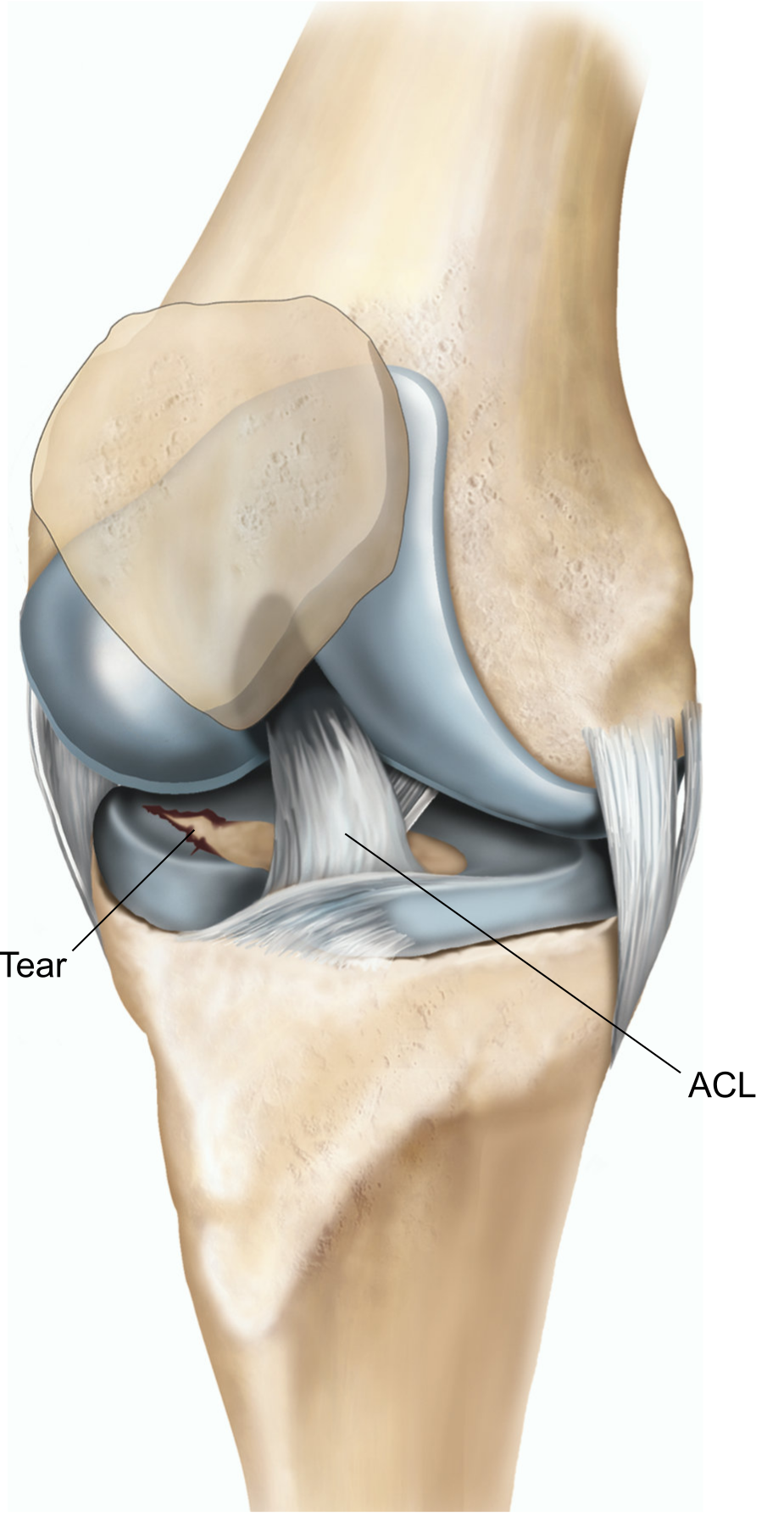 A right knee with a tear in the lateral meniscus
