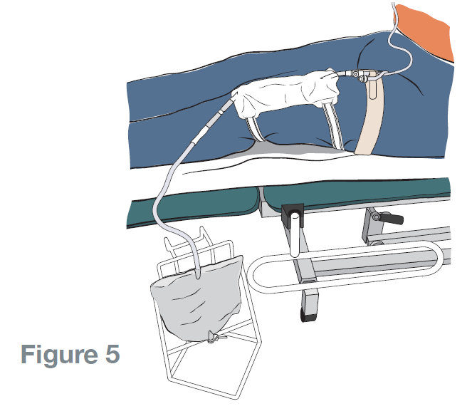 Step 9: Position the night bag or bottle below the level of your bladder. This will enable you to move in bed without the risk of pulling on your catheter