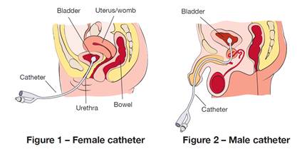 Troubleshooting for your catheter