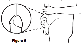 Diagram showing how to insert a catheter into a penis