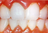 Mouth showing red, puffing gums and plaque on teeth