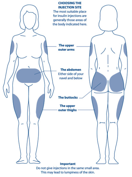 Diagram showing the areas of the body most suitable for insulin injections