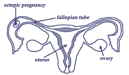 Ectopic Pregnancy: Causes, Symptoms & Treatments