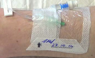 Intravenous cannula in patient's arm