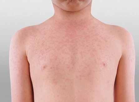 Measles rash on a boys chest