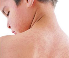 Boy with a red blotchy measles rash on his back, neck and face