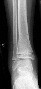 Salter Harris 1 fracture of fibia